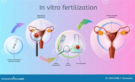 Schema di una fecondazione in vitro