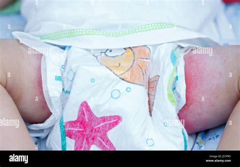 Bambino con eruzione cutanea da pannolino