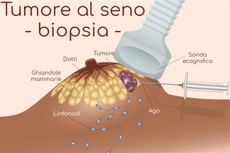 Illustrazione di vari tipi di noduli al seno (cisti, fibroadenoma, tumore)