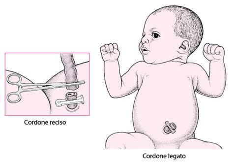 Dettaglio della cura del cordone ombelicale di un neonato