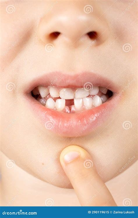 Bambino che mostra un dente da latte mancante