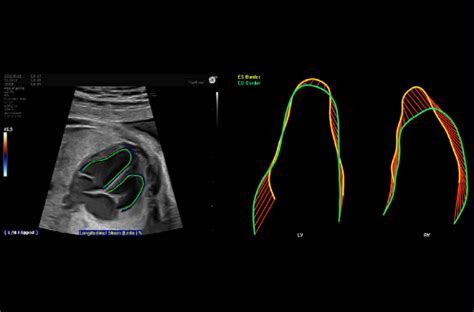 immagine illustrativa di una scansione cardiaca fetale 4D