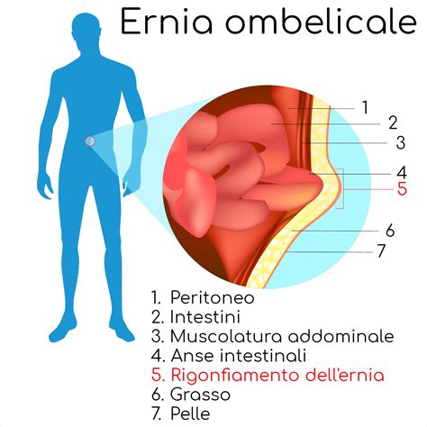 rappresentazione anatomica della regione ombelicale felina con ernia