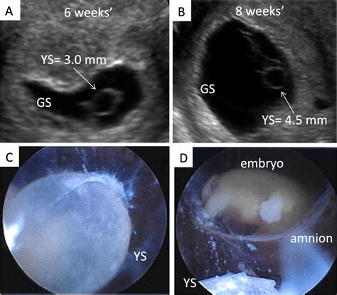 Early pregnancy ultrasound showing gestational sac and yolk sac