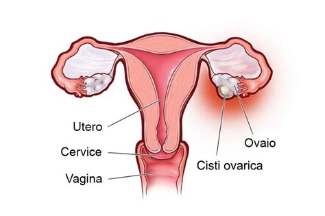 Diagramma dell'ovaio con diverse tipologie di cisti