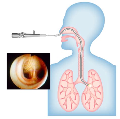 Immagine illustrativa di una broncoscopia pediatrica