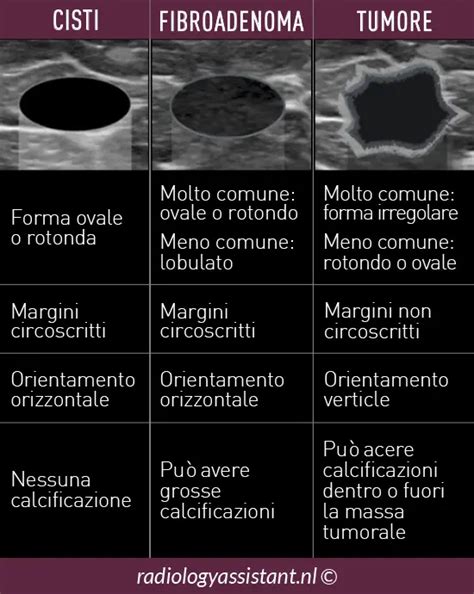 Infografica che illustra le diverse fasi della diagnosi di un nodulo al seno
