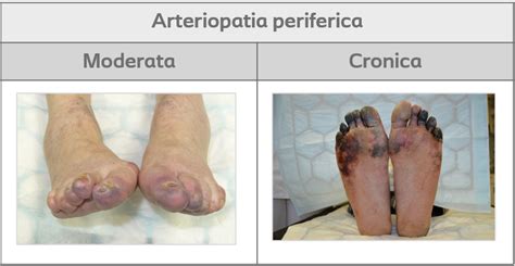 piede diabetico con ulcere