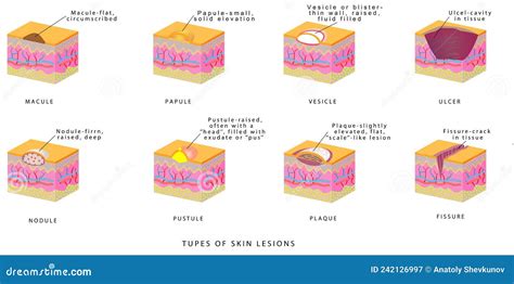 illustrazione dei diversi tipi di lesioni cutanee diabetiche