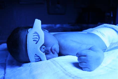 Neonato sottoposto a fototerapia