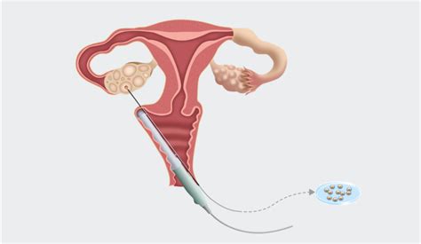Illustrazione del prelievo ovocitario ecoguidato