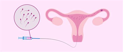 Illustrazione dell'inseminazione intrauterina (IUI)