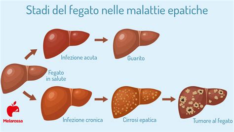 Infografica sui fattori che influenzano i livelli di bilirubina
