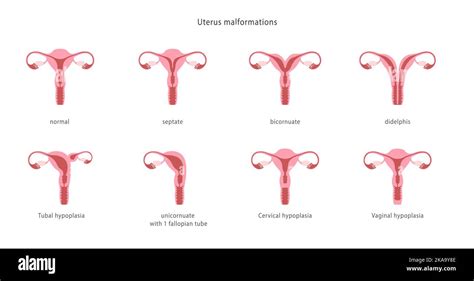 Illustrazione tipi di malformazioni uterine