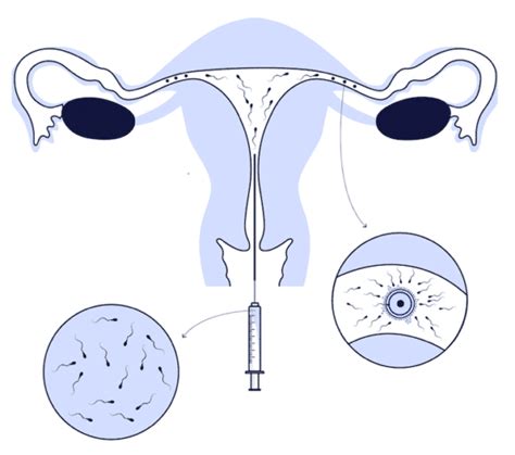 Illustrazione Inseminazione Intrauterina (IUI)