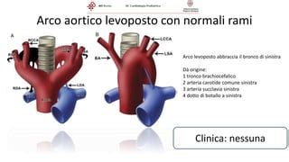 Schema dei flussi sanguigni fetali e anomalie dell'arco aortico