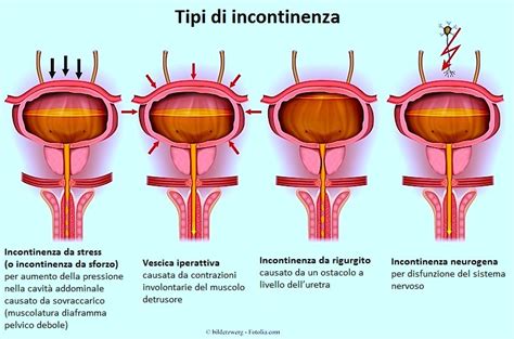 Tipi di Incontinenza Urinaria