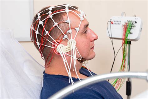 Immagine di un elettroencefalogramma (EEG) con tracciati che mostrano attività epilettiforme