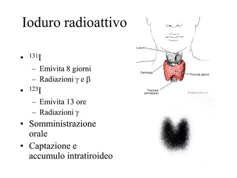 Schema del trattamento con iodio radioattivo per il cancro alla tiroide