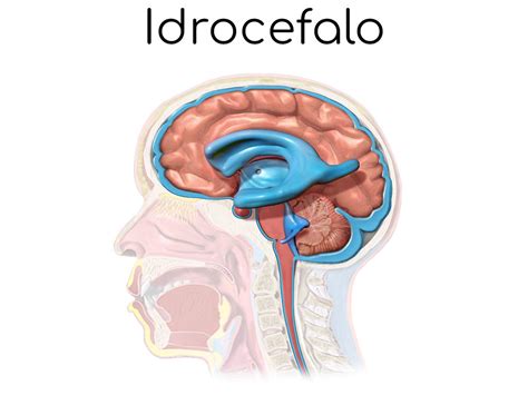 Schema che illustra le principali cause di idrocefalo ostruttivo e comunicante