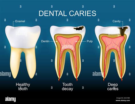 Dentini con carie
