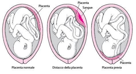 schema anatomico dell'utero con placenta inserita e rappresentazione di una zona di distacco