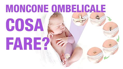 Illustrazione di un neonato con moncone ombelicale