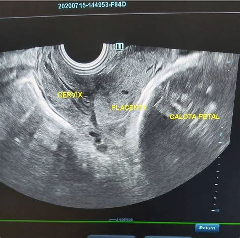 Ecografia che mostra una placenta con calcificazioni