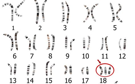 Rappresentazione microscopica di cromosomi con una trisomia evidenziata