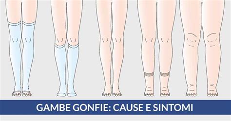 Immagine di gambe gonfie o con edema