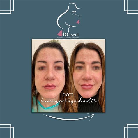 Seno svuotato prima e dopo lipofilling