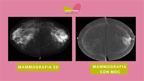 Confronto tra una mammografia durante l'allattamento e una post-allattamento, mostrando la differenza di densità