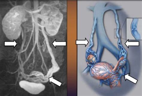 Diagramma anatomico del sistema venoso testicolare con evidenziazione del varicocele