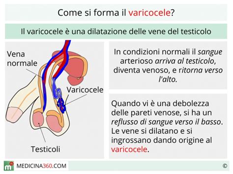 Immagine che illustra i diversi gradi di severità del varicocele