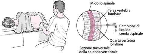 Diagramma che illustra la perdita di liquido cerebrospinale dalla dura madre dopo una puntura spinale o epidurale