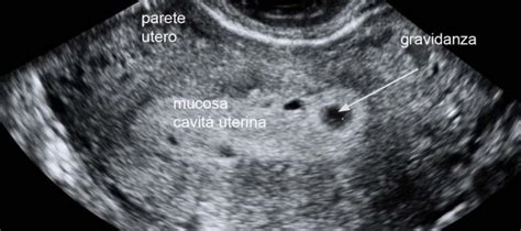 Distacco coriale ecografia
