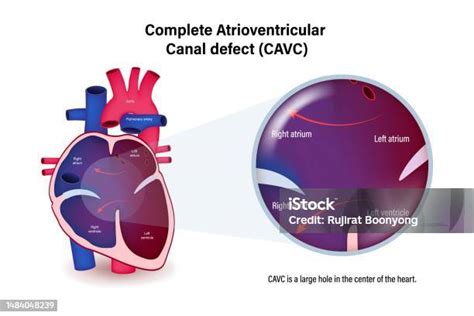 Diagramma che illustra la riparazione chirurgica del canale atrioventricolare con tecnica a due patch