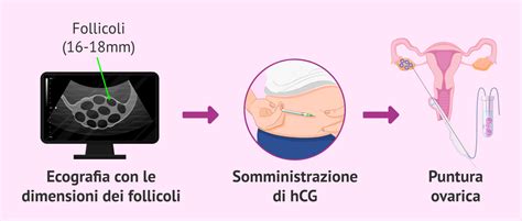 Puntura follicolare sotto guida ecografica