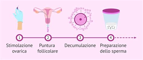 Schema della microiniezione ICSI