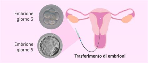 Trasferimento di embrioni nell'utero