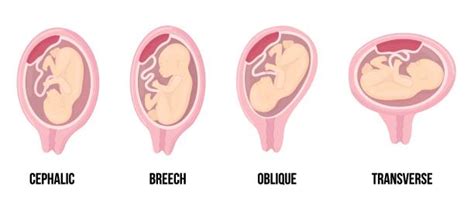 Illustrazione delle diverse posizioni della placenta nell'utero