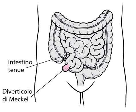 Anatomia del dotto onfalomesenterico e formazione del diverticolo di Meckel