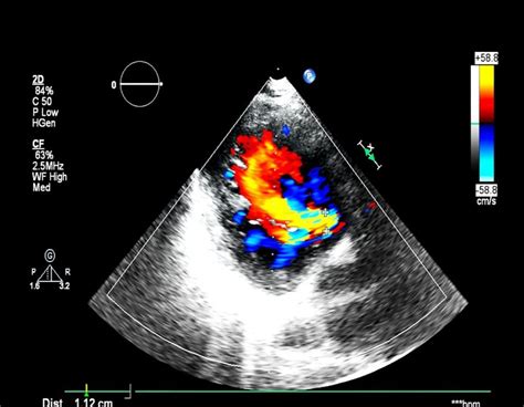 Ecocardiogramma color doppler