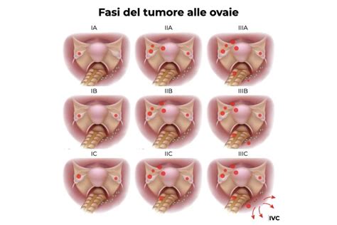Schema del processo diagnostico per il tumore ovarico