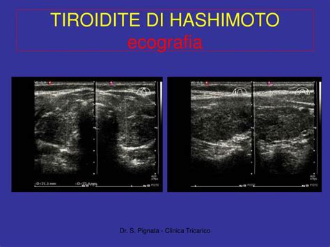 schema ecografico di una tiroide con tiroidite di Hashimoto