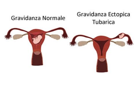Diagramma che illustra le possibili sedi di una gravidanza ectopica