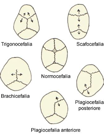 Tipi di craniosinostosi e forme craniche risultanti