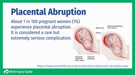Emergency delivery for placental abruption