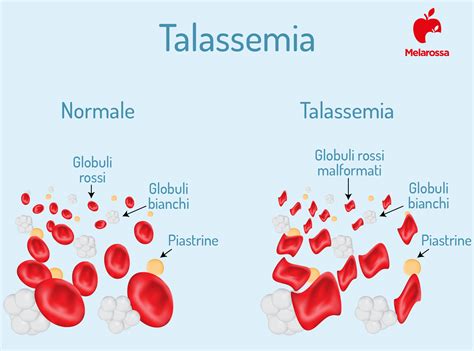 Talassemia eritrociti
