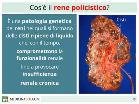 rappresentazione schematica dei reni sani a confronto con reni affetti da rene policistico